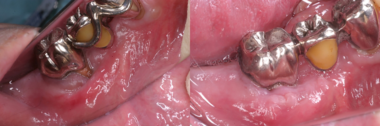 中間層の歯肉の移植　術前と術後